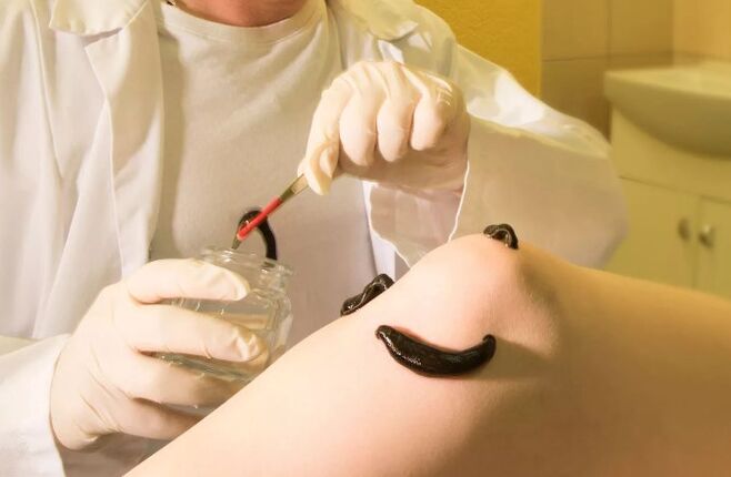Hirudoterapia per vene varicose