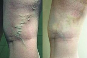 Vene varicose sulle gambe