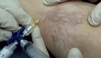 Scleroterapia per vene varicose