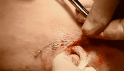 Tipi di operazioni per rimuovere le vene varicose