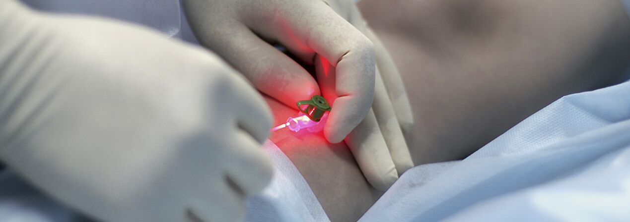 Scleroterapia compressiva